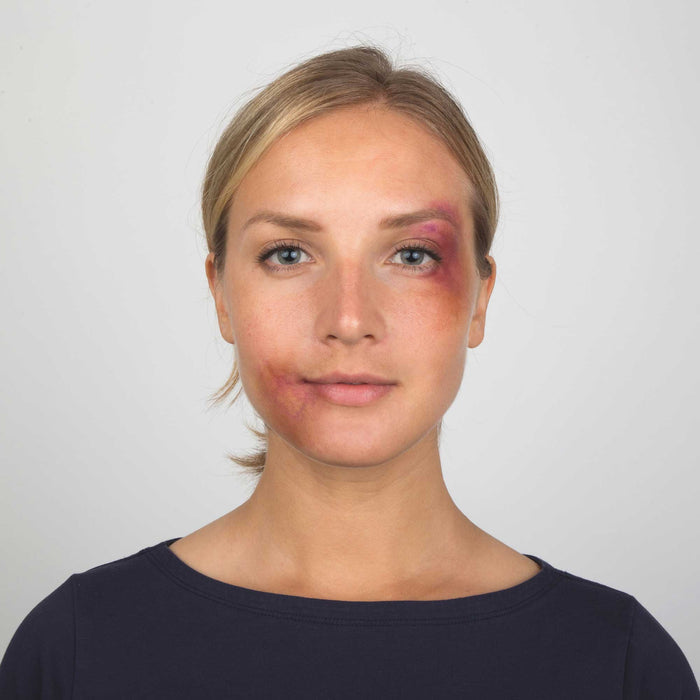 Model with cheekbone bruise SFX makeup created with the Bruise Wheel