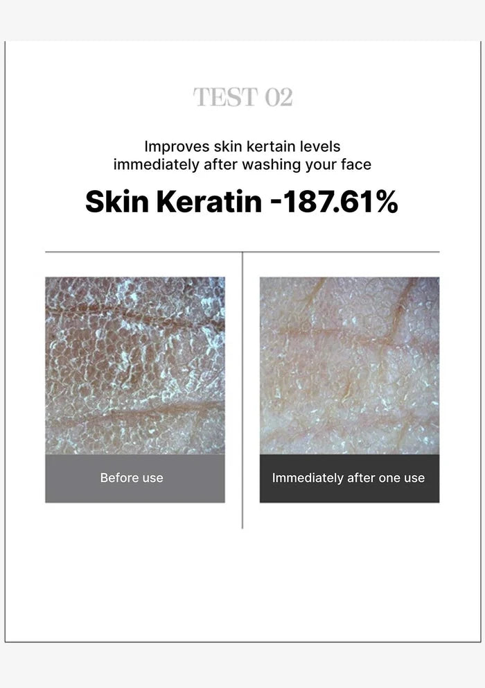 Before and after comparison of skin texture improvement with Skin Keratin, showing a decrease of 187.61%.